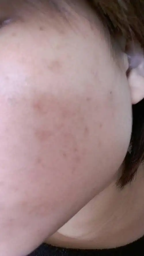 脸上快一年多的暗疮黑印,该如何淡化,有知道的人吗?