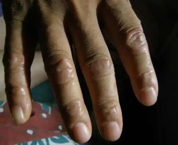 手指关节皮肤干裂,痒,局部凸起有什么办法?