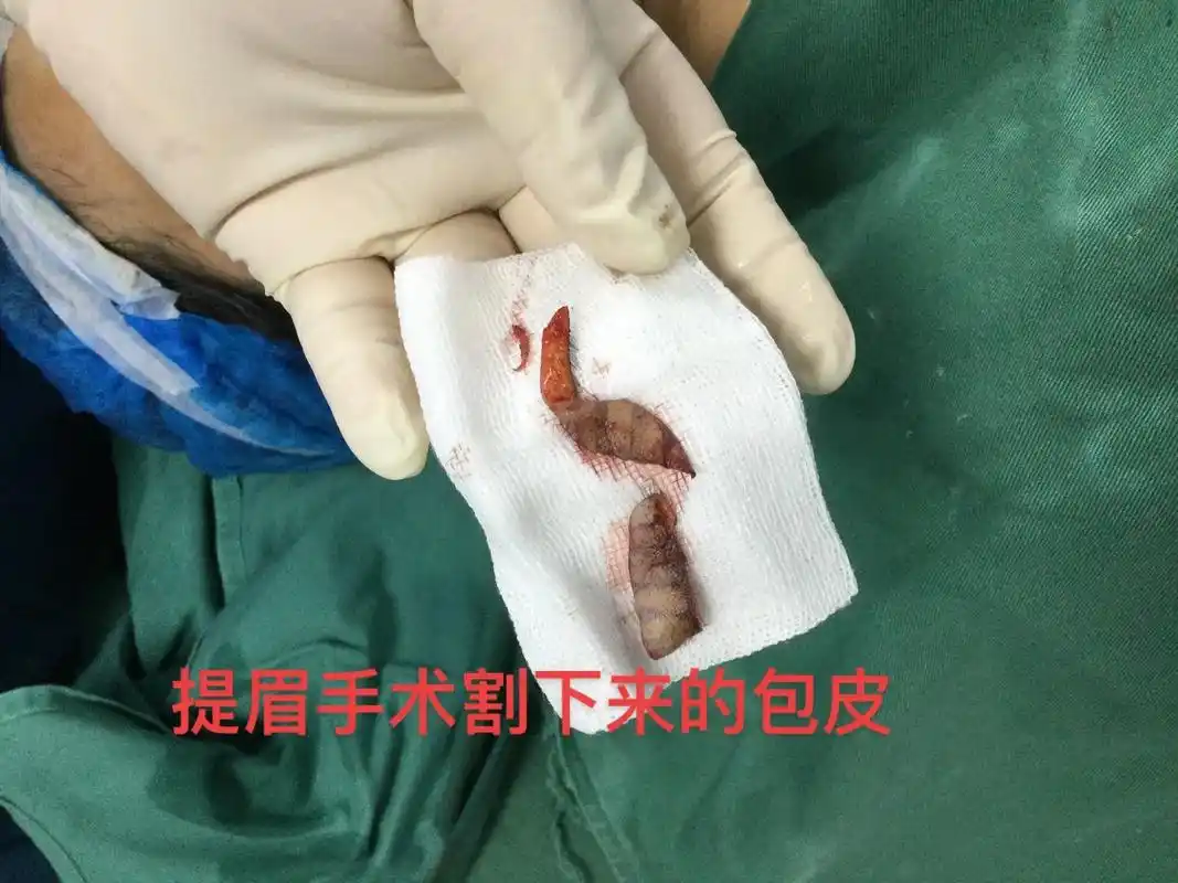 这是提眉手术当天割 - 抖音