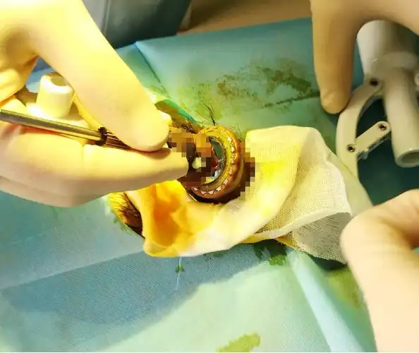 环切手术环怎么脱落 环切手术环脱落过程图片