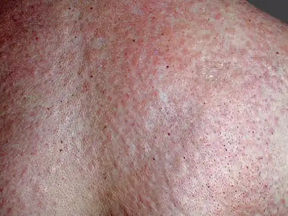 小孩荨麻疹初期症状图片分享,身体出现扁平疙瘩要重视