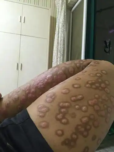 花斑癣怎么护理最好?