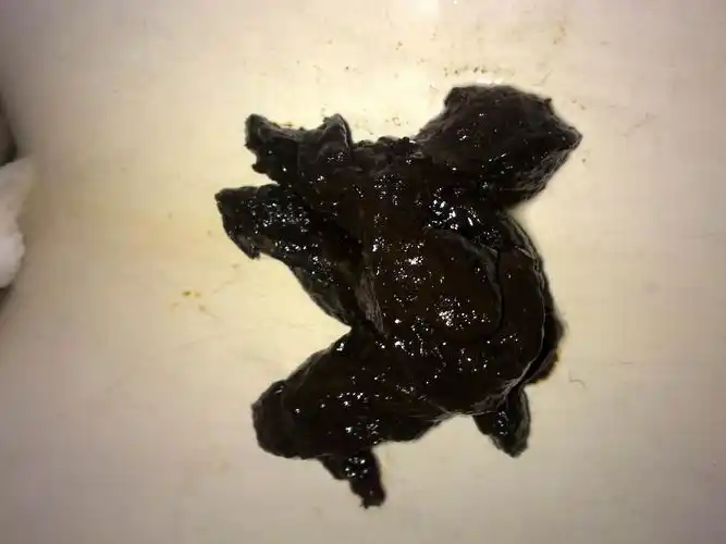 大便发黑是什么原因肝病患者大便呈这种颜色一定要引起重视啦肝硬化