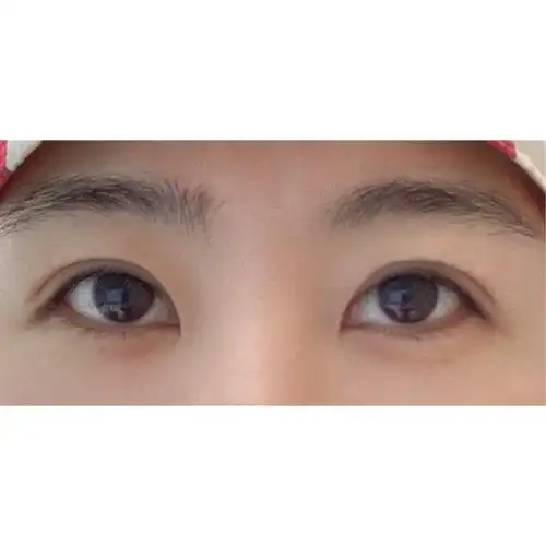 🦙大家看我术前照片是不是太难了我这个眼睛连双眼皮贴_圈子-新氧美