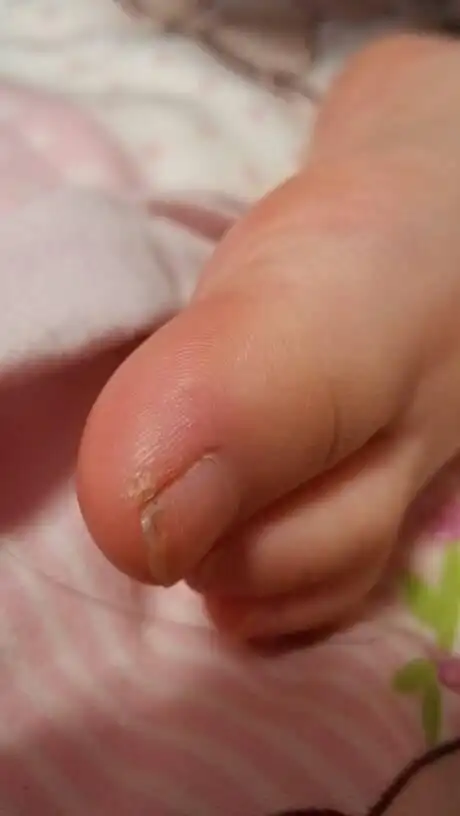 小孩子马上两岁,这个脚趾头为什么是这样的?是不是茧子?还是脚气?