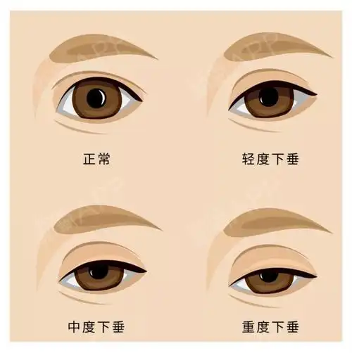 上睑下垂造成三角眼的解决方法1,切开重睑本身是单眼