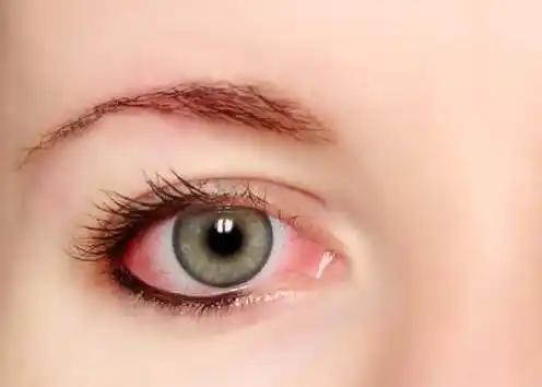 为什么你的眼睛总是很多红血丝!可能是因为这些原因!