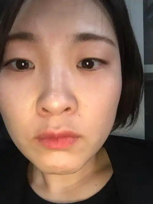 想整鼻子,但是不知道该做什么项目,感觉自己鼻孔太大,鼻翼宽,-张青松