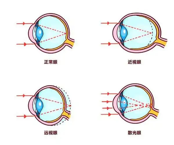 眼睛等迹象时,就应该及时找医生检查,遵从医嘱进行科学的干预和近视