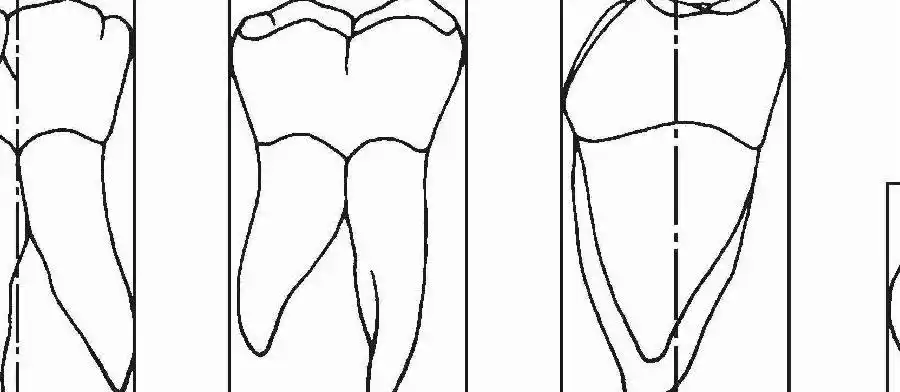 【图】牙体解剖:前牙,前磨牙,磨牙
