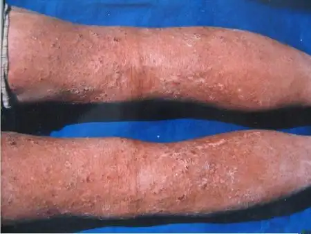 脂溢性皮炎需要与哪些疾病鉴别