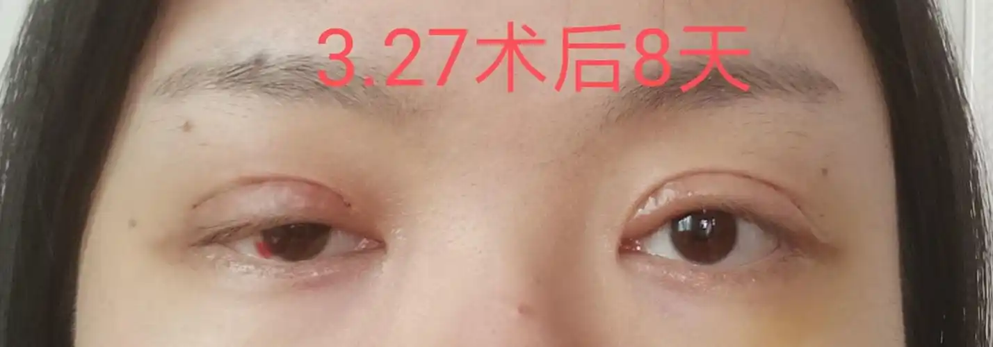记录上睑下垂 双眼皮手术后恢复过程 - 知乎