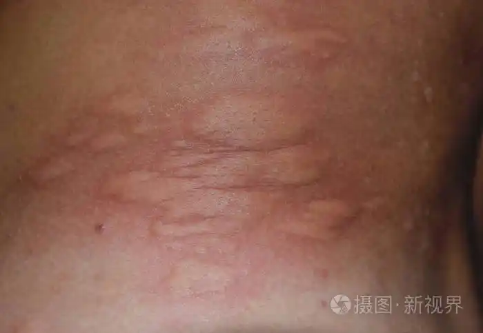 过敏皮肤背部和两侧.皮肤红肿红肿的过敏反应