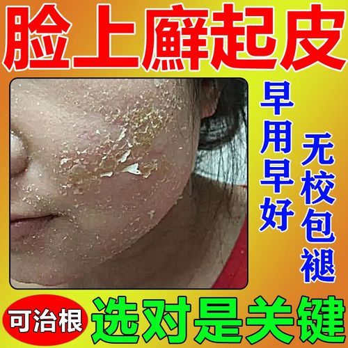 脸上起干皮皮肤癣长癣脸上皮肤干燥脱皮脸上有癣脸上起皮掉皮干皮 单