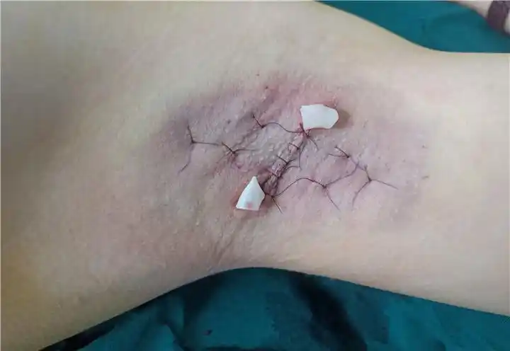 清除术腋臭微创清除术是在腋窝作一长约1-2cm的小切口,然后在腋下大汗