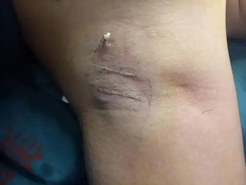 微创腋臭手术~让生活不再尴尬