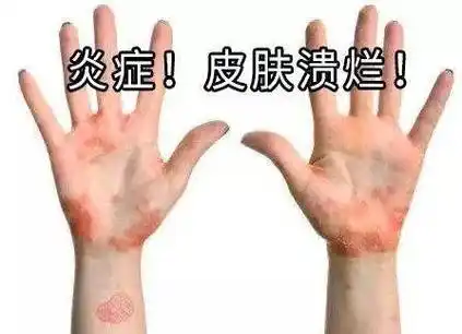 被湿疹折磨的苦不堪言?那是因为你没有用对方法!_消炎