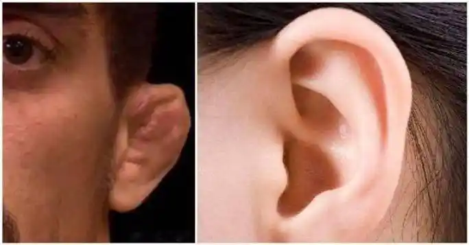 饺子耳vs正常耳朵