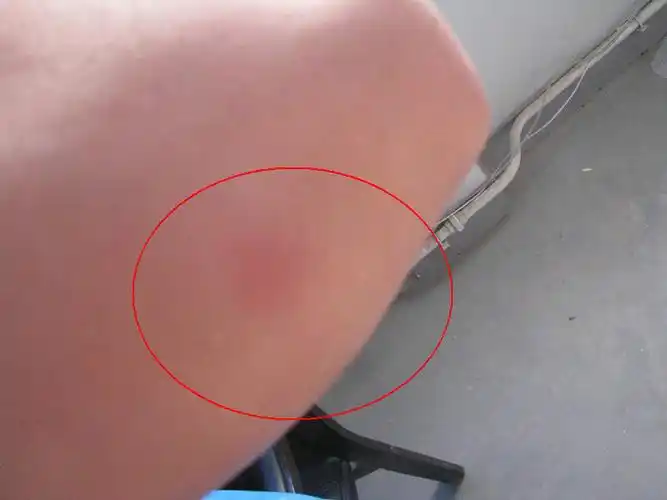 蜘蛛叮咬记(图) - 离开家的日子 - 边城岁月