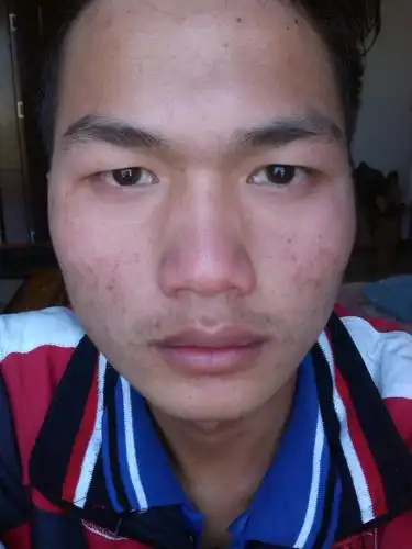 毛孔粗大, 有痘印