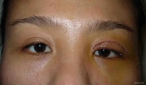 【讨论】上睑下垂提上睑肌短缩术后,重睑形成失败,什么原因? [病例帖]