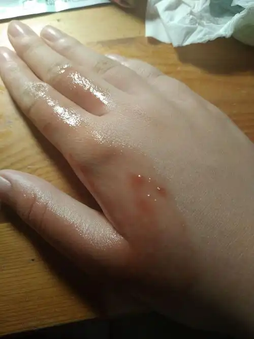 手被开水烫伤了怎么办