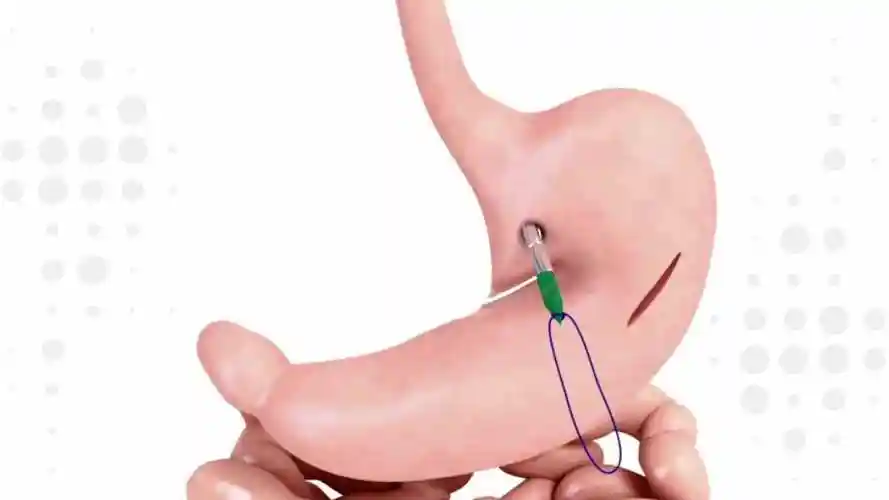 吻合器端侧吻合示意