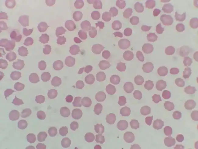 外周血涂片可见棘形红细胞,头盔形红细胞,破碎红细胞占7%.如图1