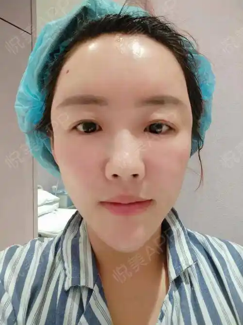 术后即刻脸部饱满了,脂肪填充后的脸确实会有些肿,我.