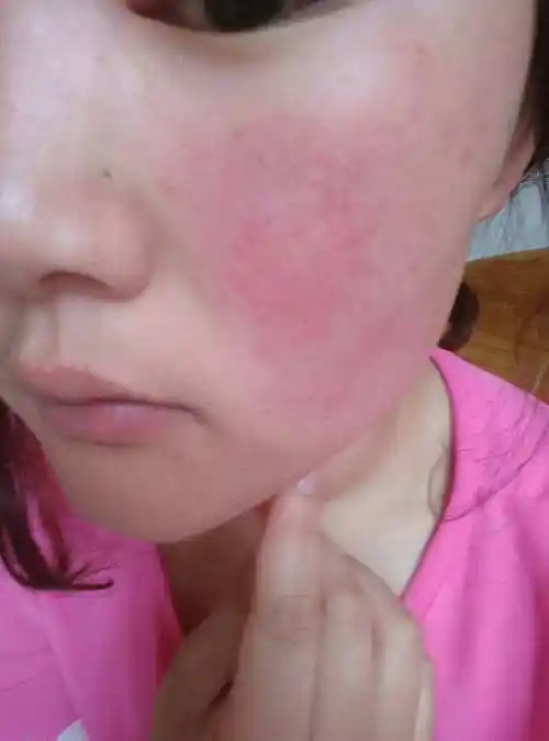 如何去除脸上红血丝?