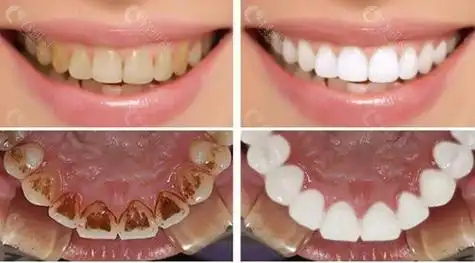 东莞南城固德口腔牙齿美白前后对比图