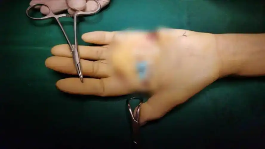 秋冬手指发冷发麻可能是这种女性更易患的罕见病严重要截肢