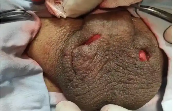 请教双侧睾丸切除术的两个问题