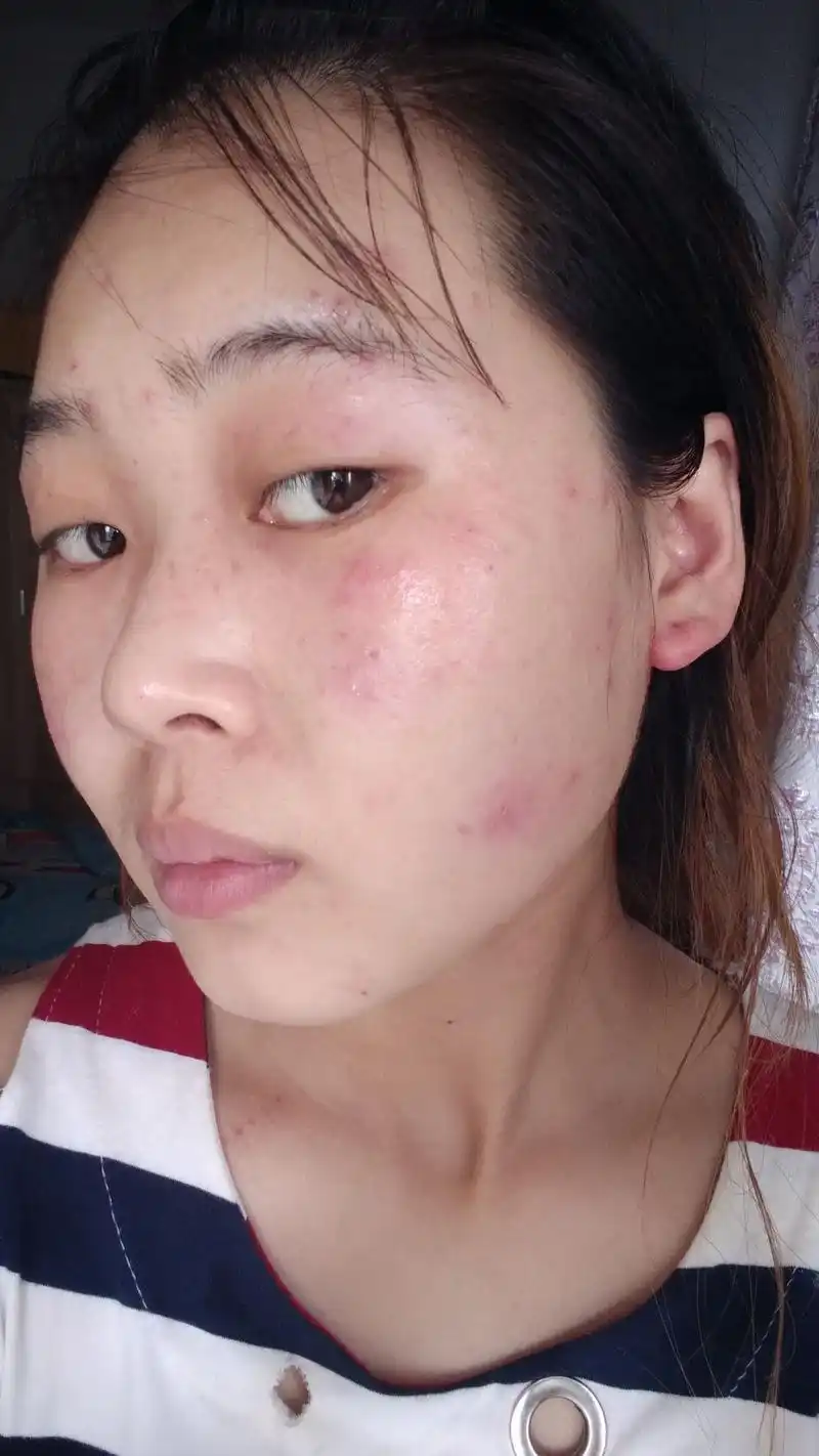 都不敢出门了,护肤品也没有换,是过敏吗?还是