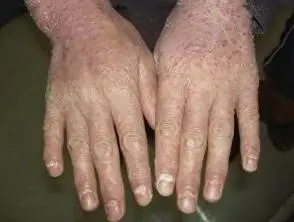 牛皮肤癣初期的症状图片_银屑病求医网