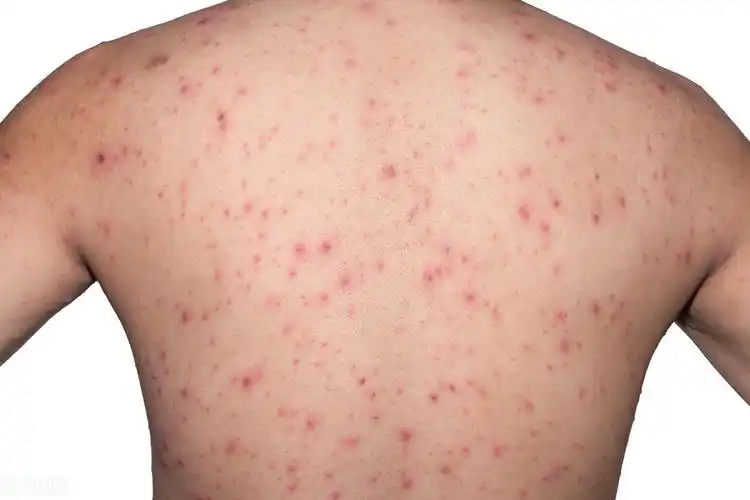 医生:春季水痘高发,及时隔离很重要