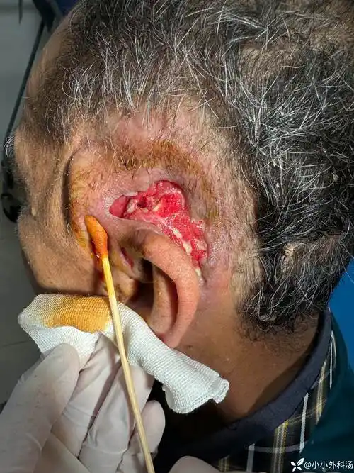 求助,耳廓脓肿术后伤口下一步处理