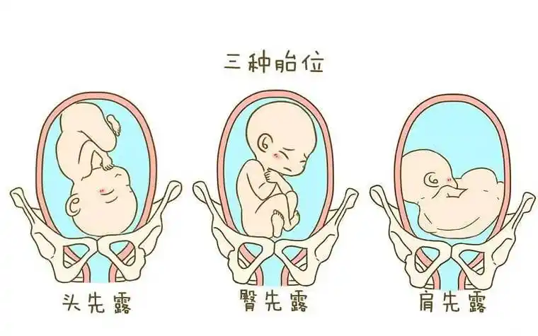 右三为横位此为头位,臀位,横位示意图,横位常常是肩先露,三种胎位进行