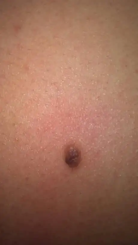 背上有个大痣,大约6到8mm,旁边还有个小的,大概有两三年了,,请问有