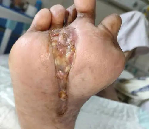 严重感染的糖尿病足险遭截肢最后一个足趾都不少这样处理最有效