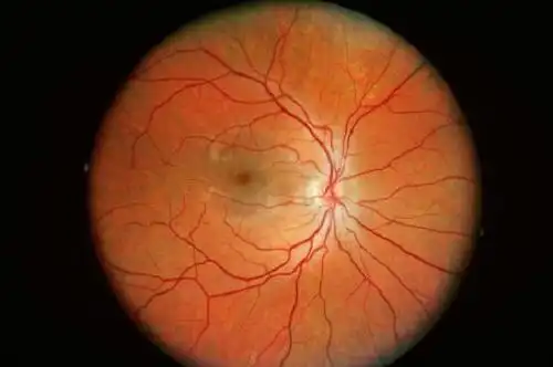 验光300度近视,也可能是高度近视吗?