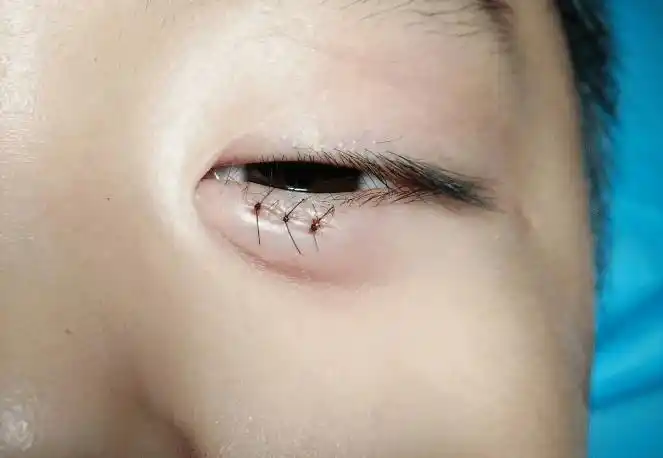 假期到来,家长必备:儿童眼外伤的正确处理方式_眼球_伤口_孩子