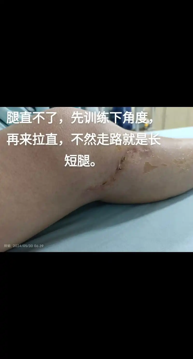 度,医生掰才能90度,什么时候才能到120度[流泪][流泪][流泪]我想出院