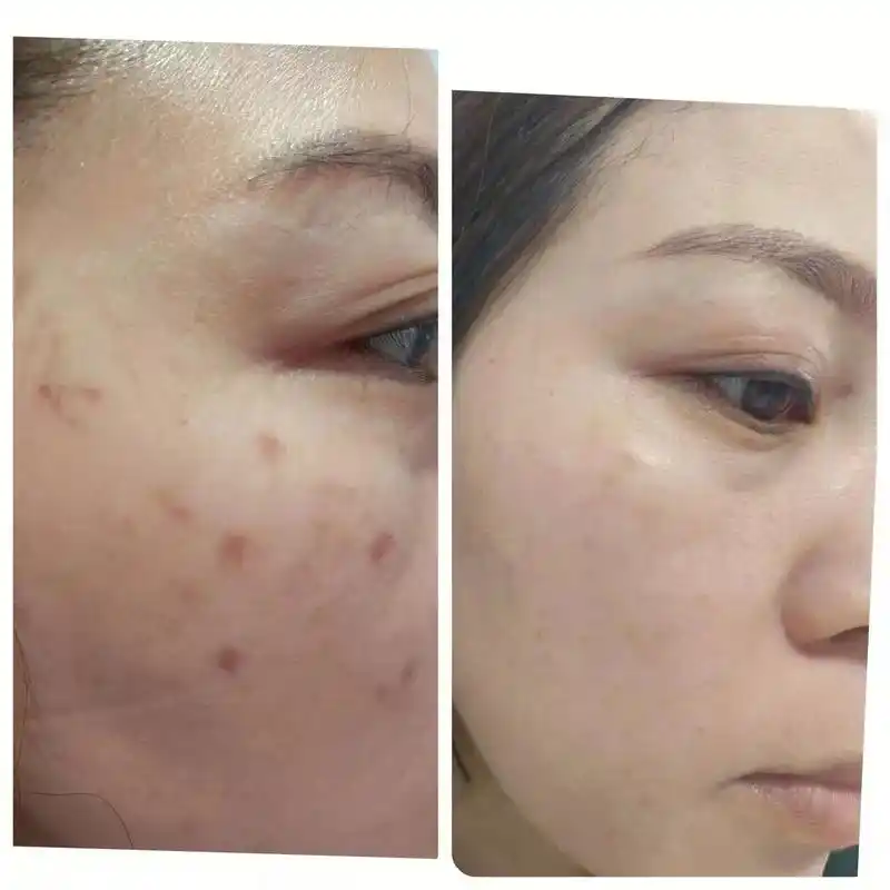 同城美容 #美业人 #真实客照 #袪斑 #解决任何皮肤问题 - 抖音