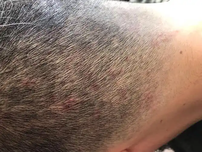 头皮上有很多红疙瘩