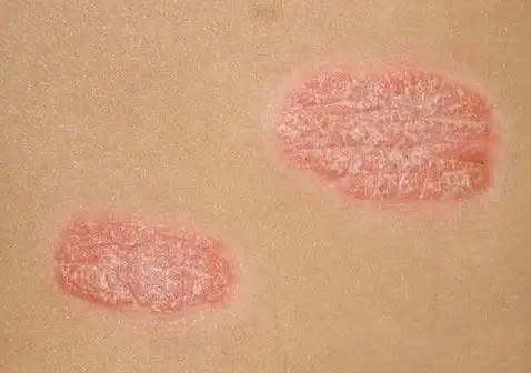 牛皮癣儿童早起图片_银屑病求医网