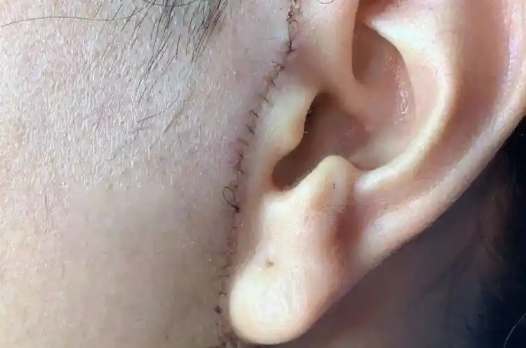 深层了解小切口拉皮手术可以维持多久,面部拉皮手术可以保持多久?