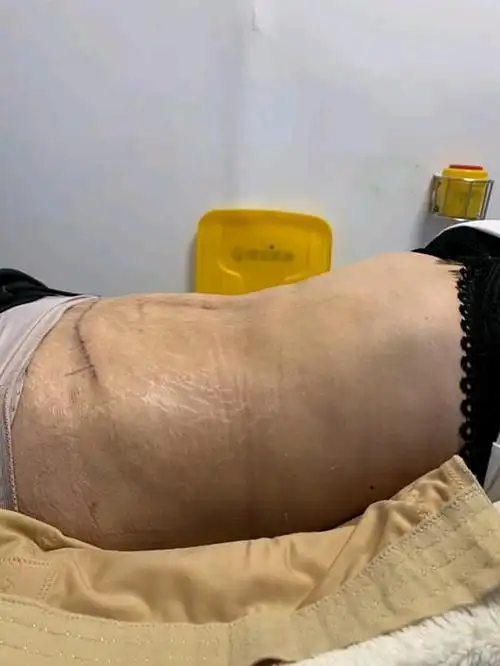 这是15天拆线陈主任拍的我是做的腰腹环吸77腹壁成型_圈子-新氧美容