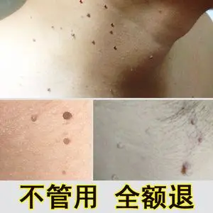 祛脖子上丝状尤刺猴瘊子皮赘肉痣肉芽皮肤长小肉粒疙瘩正品去除膏