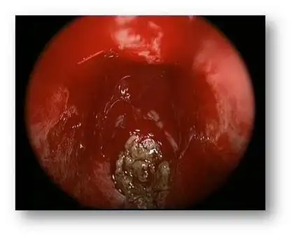 什么是真菌性鼻窦炎